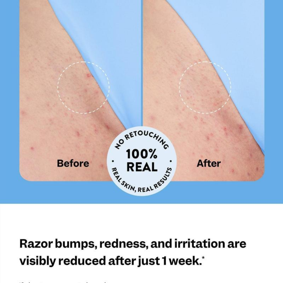 Ingrown Hair Roller