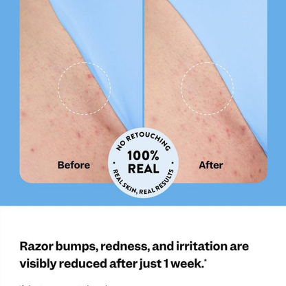 Ingrown Hair Roller